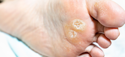 Callus