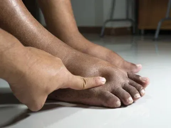 Diabetic Neuropathy