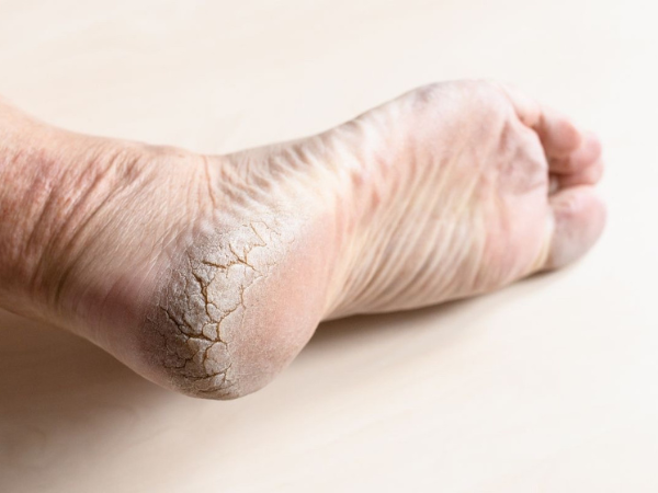 Dry & Cracked Feet