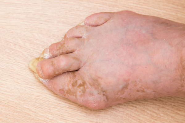 Infection Management