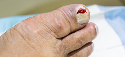 Ingrown Toenail