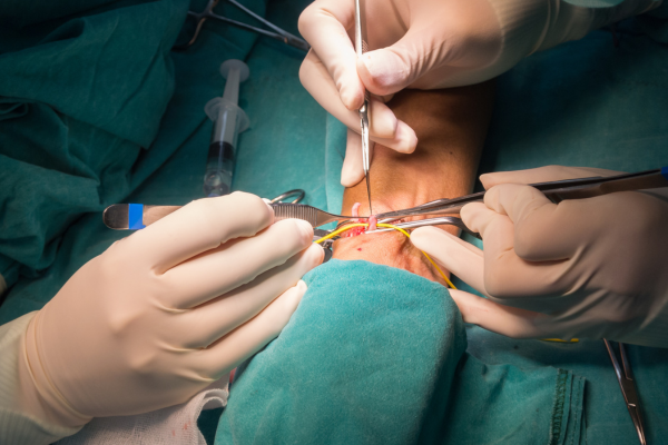 Limb Salvage Surgery