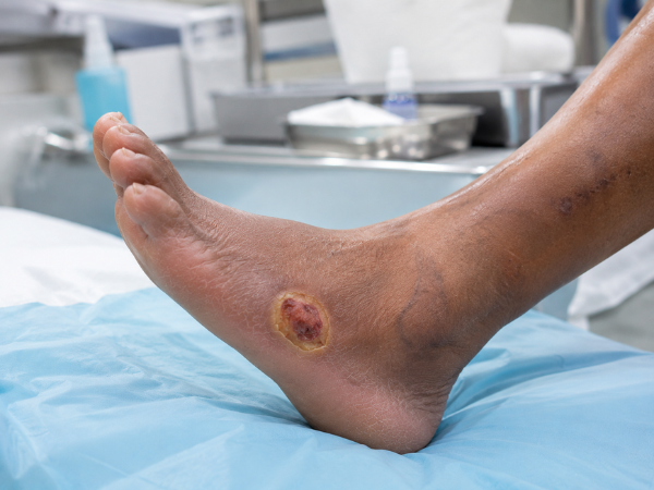Neuro-Ischemic Ulcer