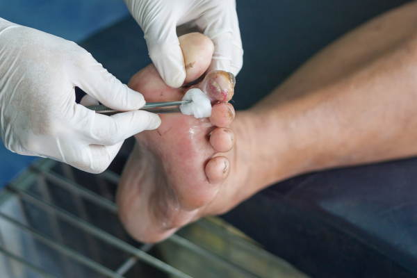 Offloading & Preventive Surgery