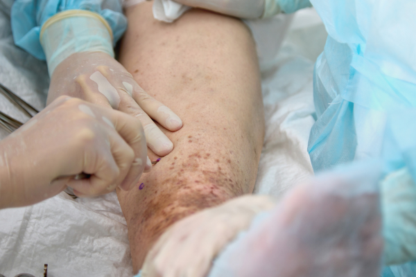 Open Vascular Surgery